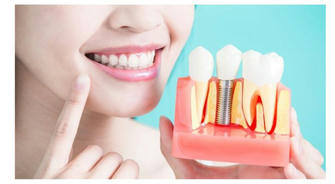 How to Get a Perfect Smile with Dental Implants Without Breaking the Bank