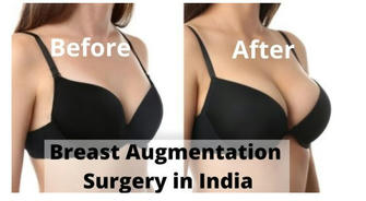 Breast Augmentation Before and After: Have You Seen These Real Results?