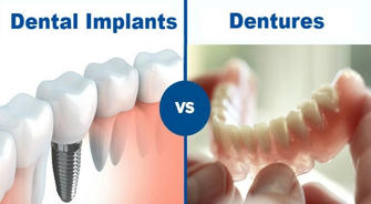 Are Dental Implants Really Better Than Dentures?